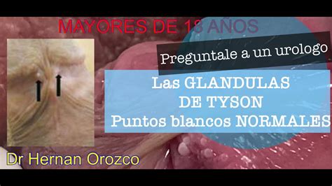 que son glandulas de tyson|¿Por qué salen las glándulas de Tyson o bolitas。